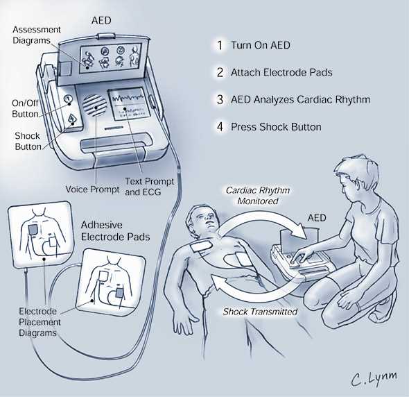 diagram defibrillator parts