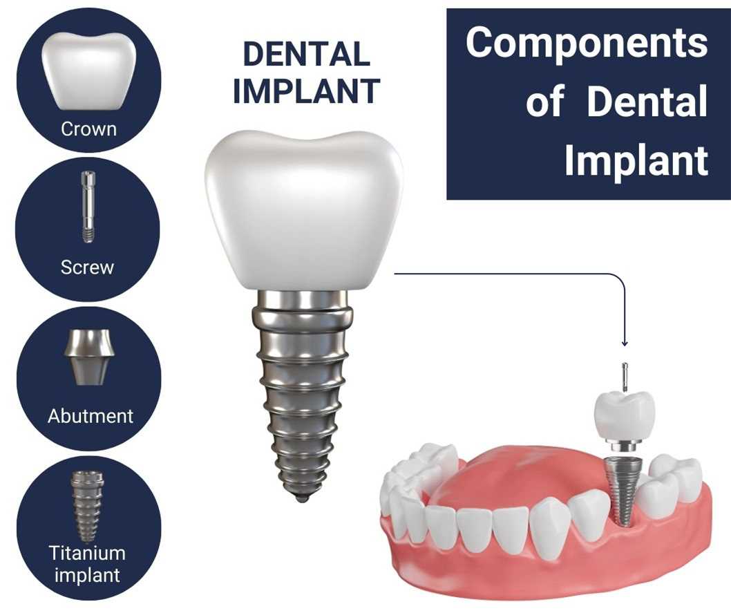 dental implant parts diagram