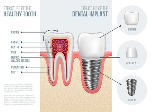 dental implants parts diagram