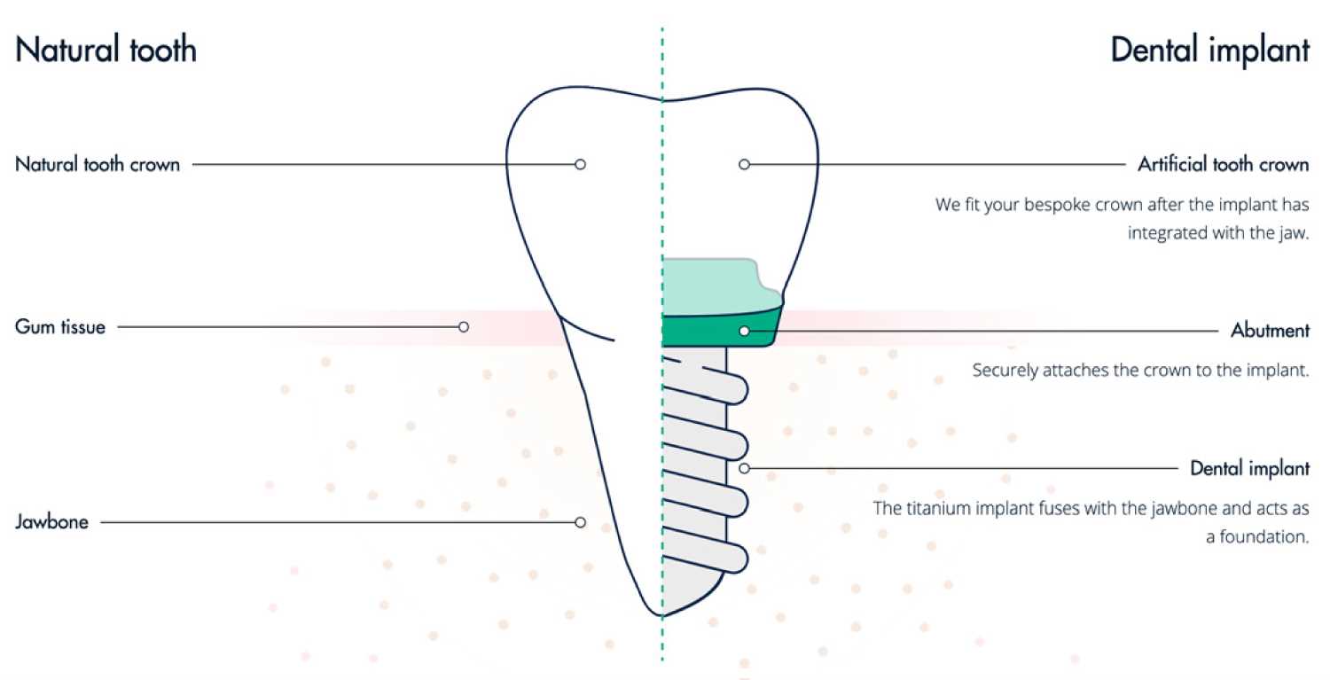 dental implants parts diagram