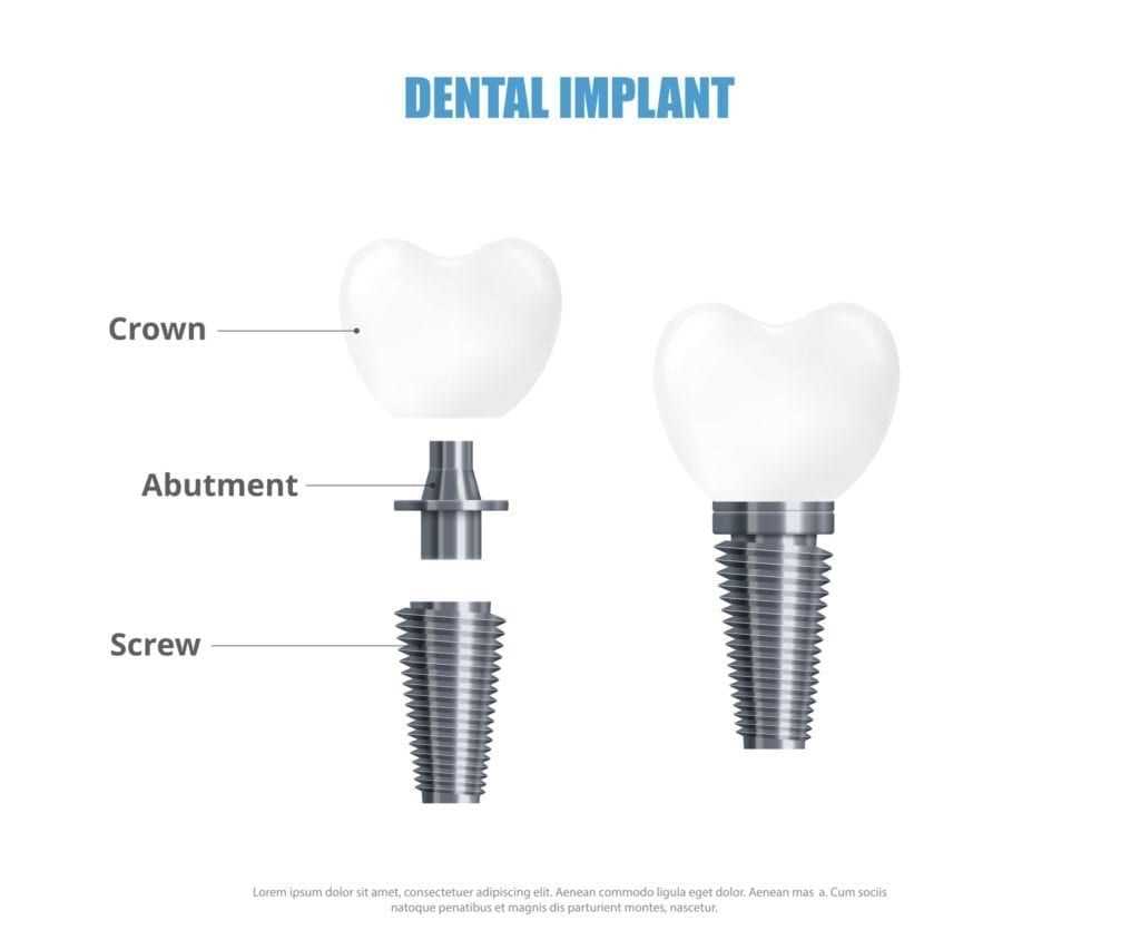 dental implant parts diagram